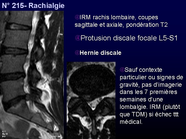 N° 215 - Rachialgie IRM rachis lombaire, coupes sagittale et axiale, pondération T 2