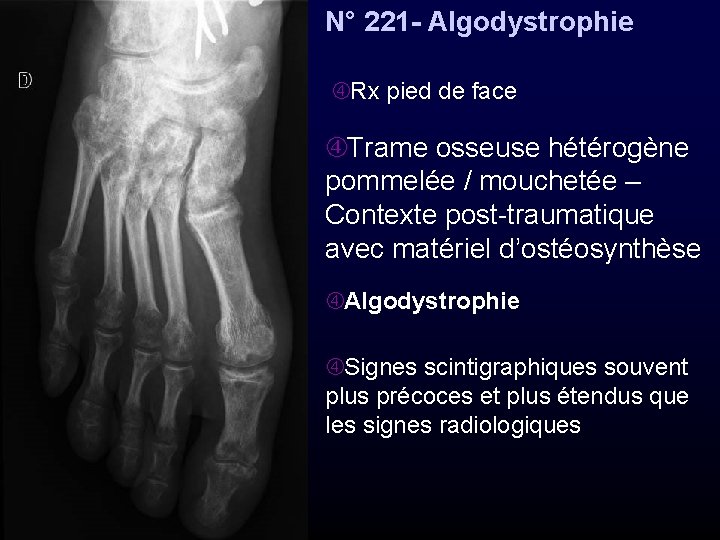 N° 221 - Algodystrophie Rx pied de face Trame osseuse hétérogène pommelée / mouchetée
