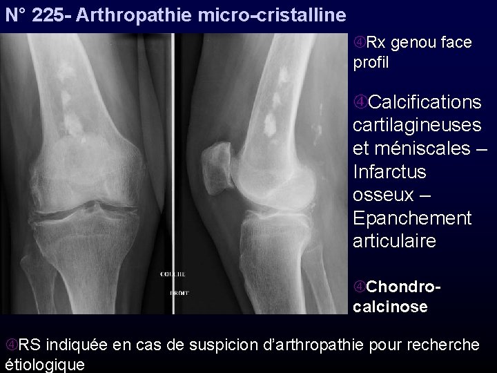 N° 225 - Arthropathie micro-cristalline Rx genou face profil Calcifications cartilagineuses et méniscales –