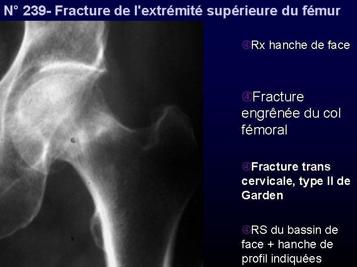 N° 239 - Fracture de l'extrémité supérieure du fémur Rx hanche de face Fracture