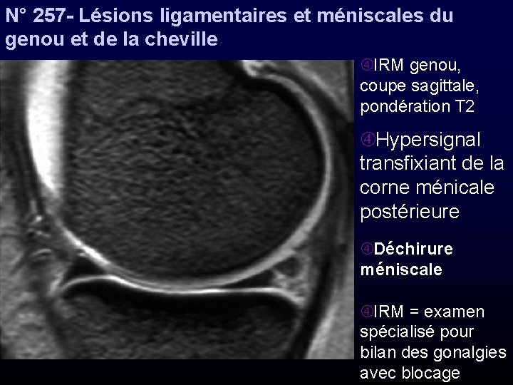 N° 257 - Lésions ligamentaires et méniscales du genou et de la cheville IRM