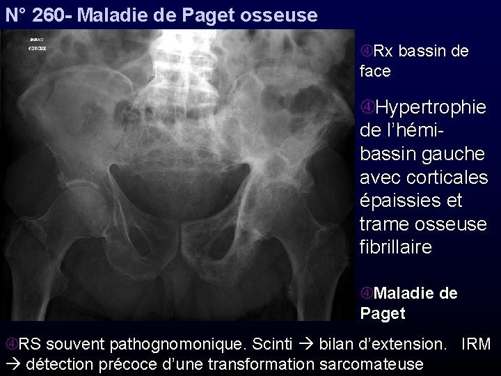 N° 260 - Maladie de Paget osseuse Rx bassin de face Hypertrophie de l’hémibassin