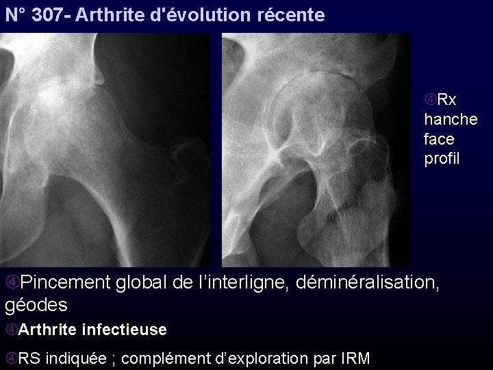 N° 307 - Arthrite d'évolution récente Rx hanche face profil Pincement global de l’interligne,