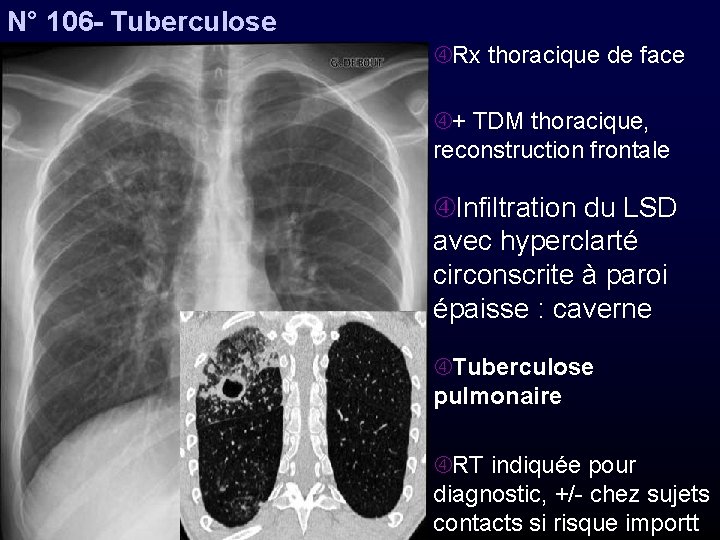 N° 106 - Tuberculose Rx thoracique de face + TDM thoracique, reconstruction frontale Infiltration