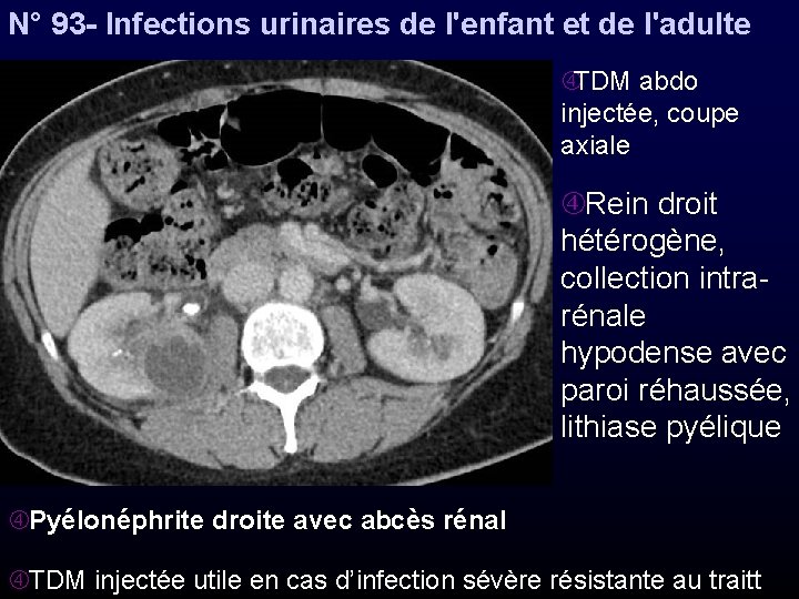 N° 93 - Infections urinaires de l'enfant et de l'adulte TDM abdo injectée, coupe