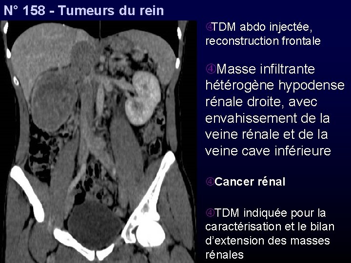 N° 158 - Tumeurs du rein TDM abdo injectée, reconstruction frontale Masse infiltrante hétérogène