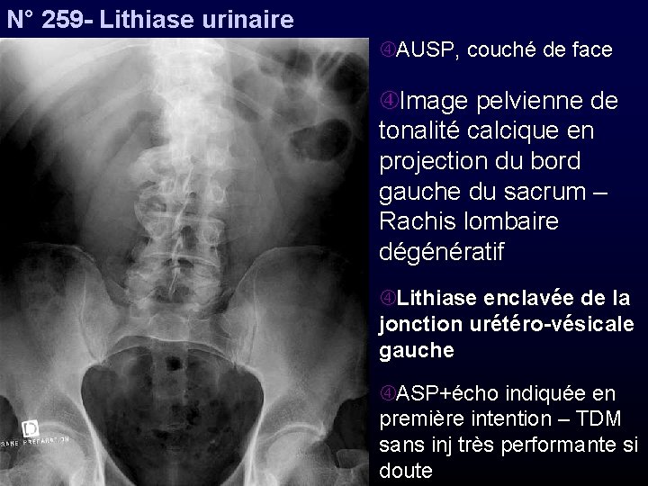 N° 259 - Lithiase urinaire AUSP, couché de face Image pelvienne de tonalité calcique