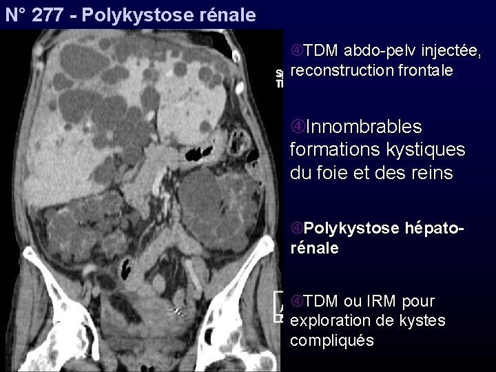 N° 277 - Polykystose rénale TDM abdo-pelv injectée, reconstruction frontale Innombrables formations kystiques du