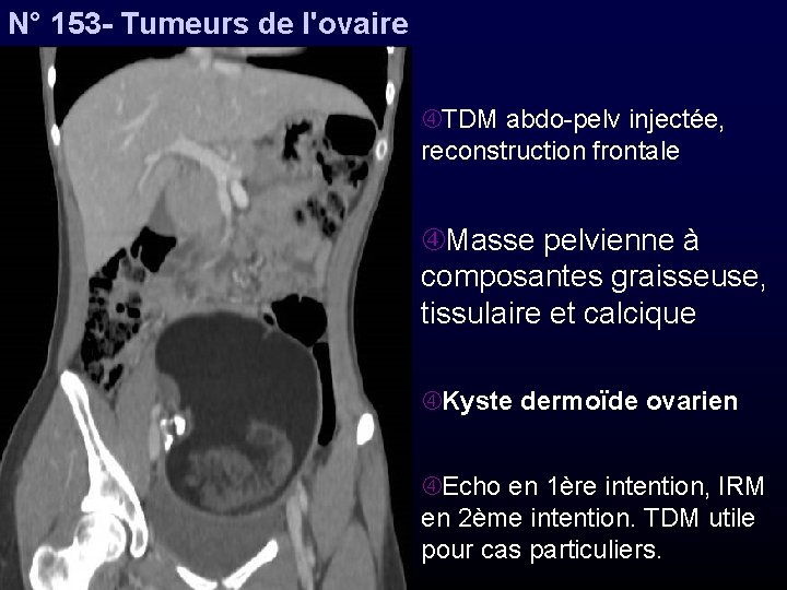 N° 153 - Tumeurs de l'ovaire TDM abdo-pelv injectée, reconstruction frontale Masse pelvienne à