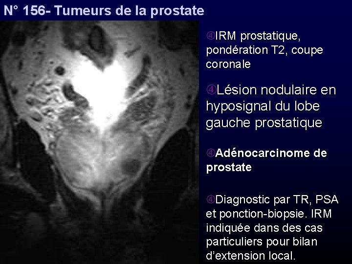 N° 156 - Tumeurs de la prostate IRM prostatique, pondération T 2, coupe coronale