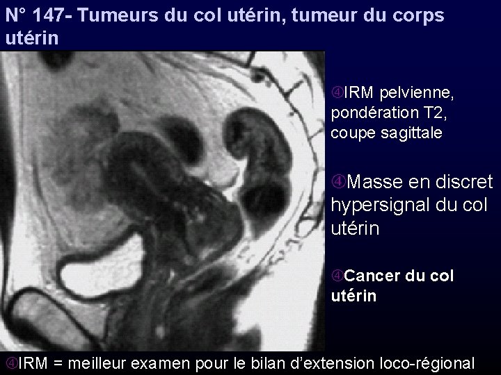 N° 147 - Tumeurs du col utérin, tumeur du corps utérin IRM pelvienne, pondération