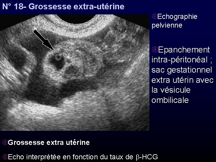 N° 18 - Grossesse extra-utérine Echographie pelvienne Epanchement intra-péritonéal ; sac gestationnel extra utérin