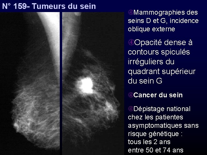 N° 159 - Tumeurs du sein Mammographies des seins D et G, incidence oblique