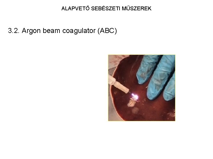 ALAPVETŐ SEBÉSZETI MŰSZEREK 3. 2. Argon beam coagulator (ABC) 