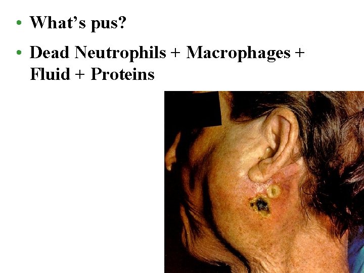  • What’s pus? • Dead Neutrophils + Macrophages + Fluid + Proteins 