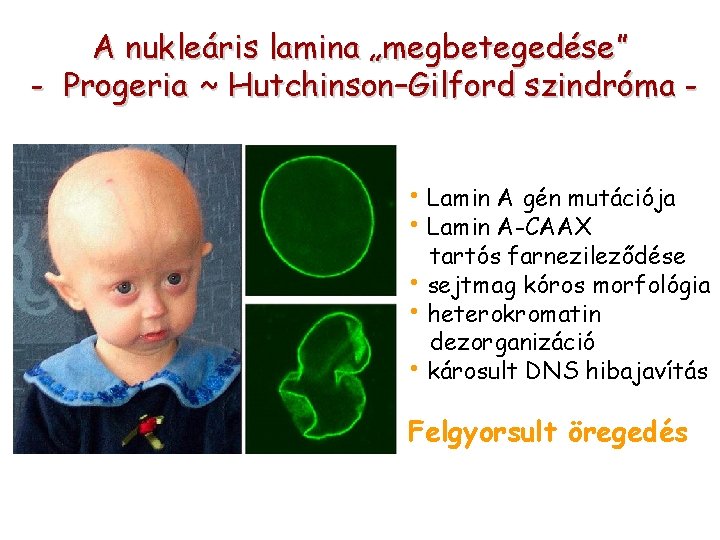 A nukleáris lamina „megbetegedése” - Progeria ~ Hutchinson–Gilford szindróma • Lamin A gén mutációja