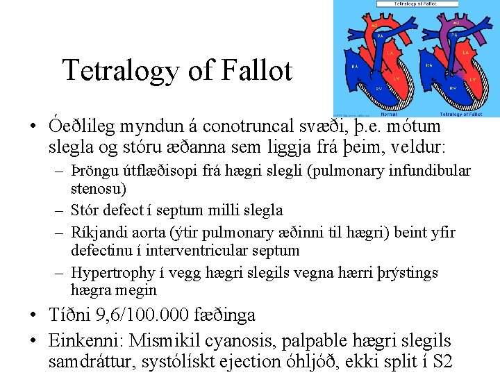 Tetralogy of Fallot • Óeðlileg myndun á conotruncal svæði, þ. e. mótum slegla og