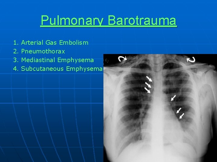 Pulmonary Barotrauma 1. 2. 3. 4. Arterial Gas Embolism Pneumothorax Mediastinal Emphysema Subcutaneous Emphysema