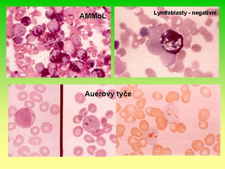 AMMo. L Auerovy tyče Lymfoblasty - negativní 