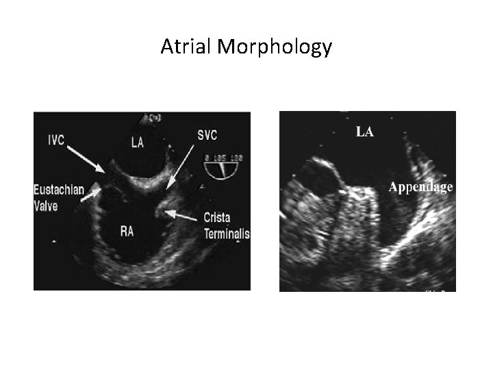 Atrial Morphology 