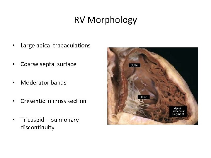 RV Morphology • Large apical trabaculations • Coarse septal surface • Moderator bands •