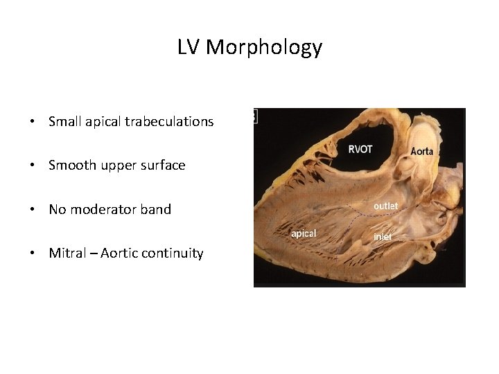 LV Morphology • Small apical trabeculations • Smooth upper surface • No moderator band