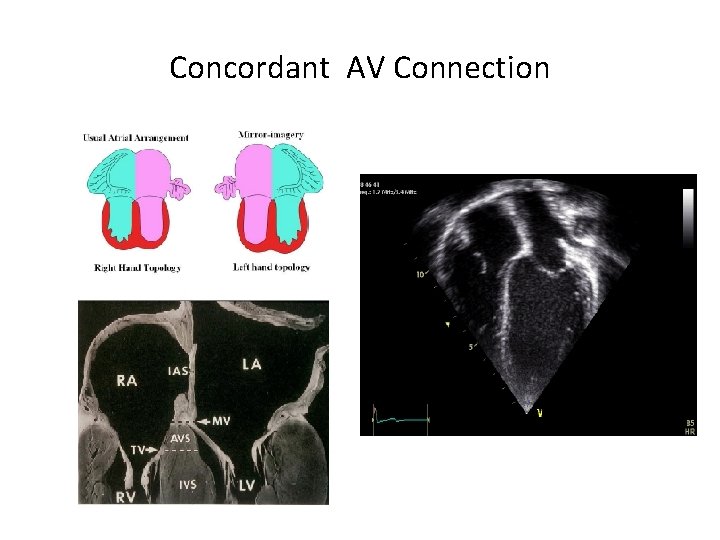 Concordant AV Connection 