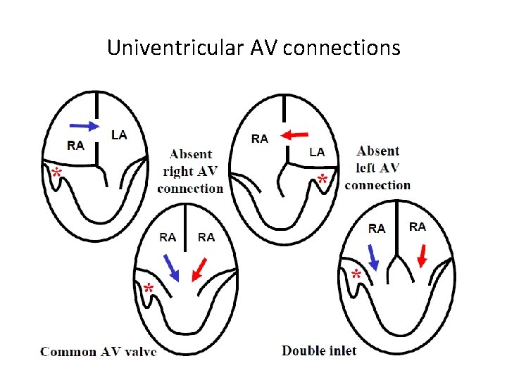Univentricular AV connections 