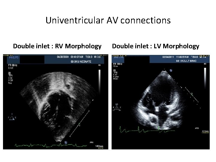 Univentricular AV connections Double inlet : RV Morphology Double inlet : LV Morphology 