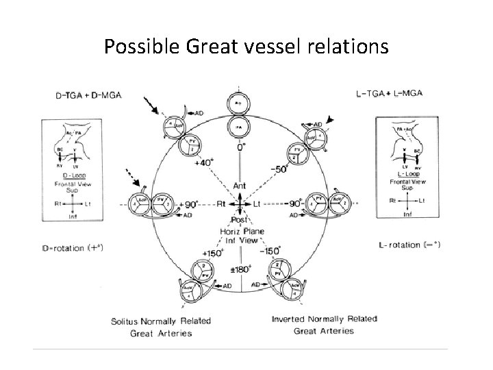 Possible Great vessel relations 