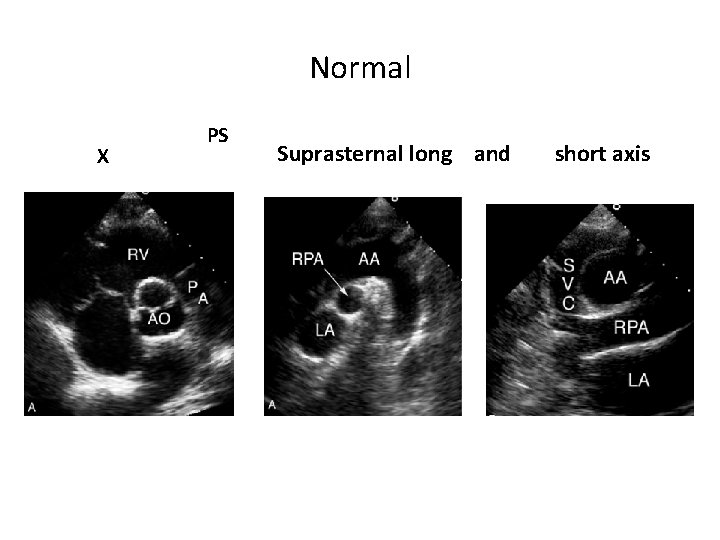 Normal X PS Suprasternal long and short axis 