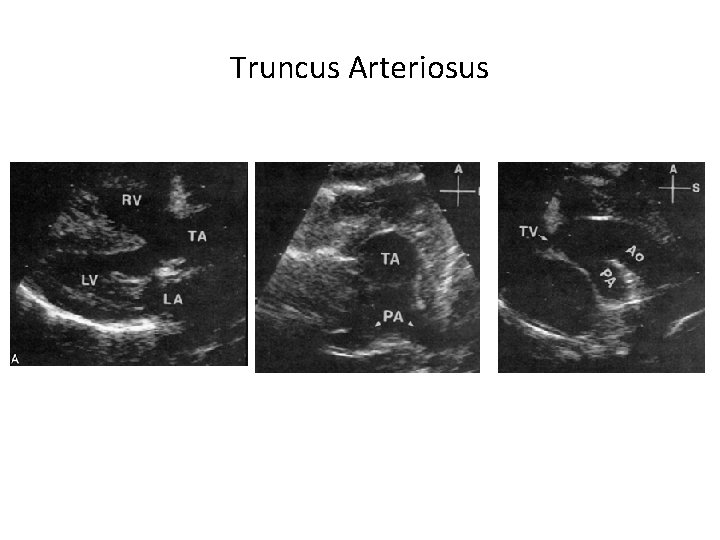 Truncus Arteriosus 