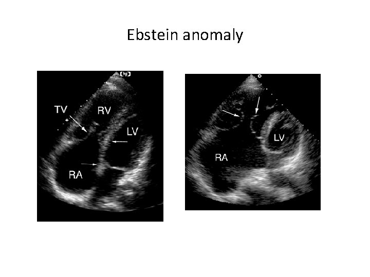 Ebstein anomaly 