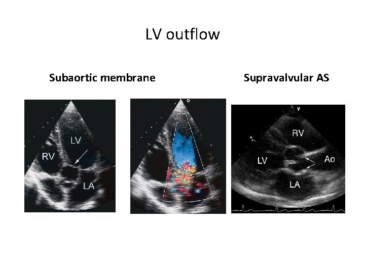 LV outflow Subaortic membrane Supravalvular AS 