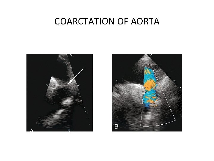 COARCTATION OF AORTA 