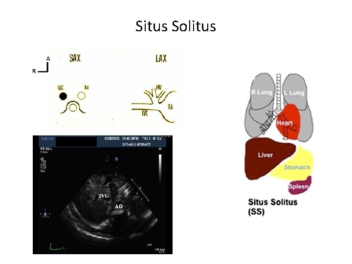 Situs Solitus 