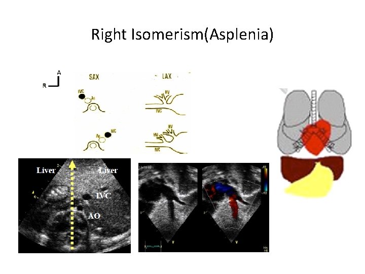 Right Isomerism(Asplenia) 