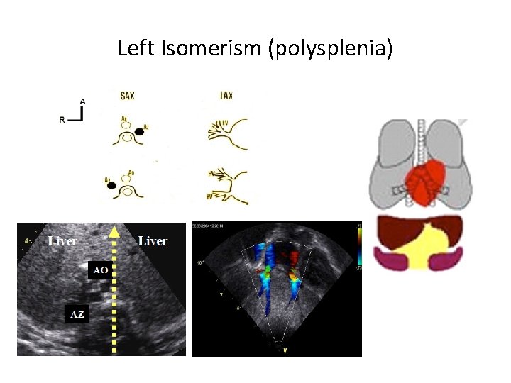 Left Isomerism (polysplenia) 