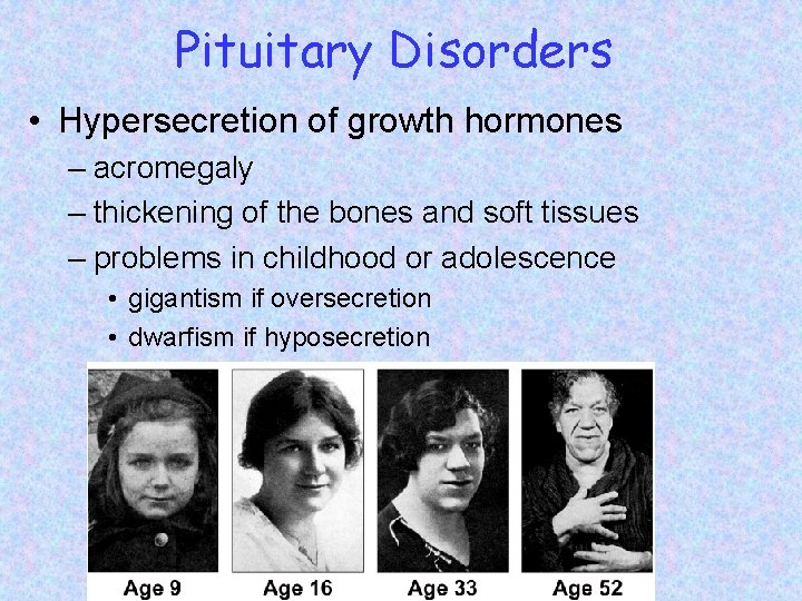 Pituitary Disorders • Hypersecretion of growth hormones – acromegaly – thickening of the bones