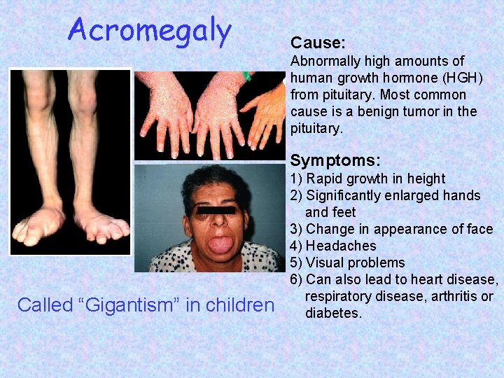 Acromegaly Cause: Abnormally high amounts of human growth hormone (HGH) from pituitary. Most common