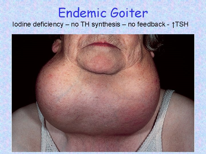Endemic Goiter Iodine deficiency – no TH synthesis – no feedback - ↑TSH 