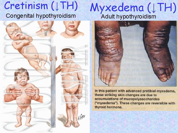 Cretinism (↓TH) Congenital hypothyroidism Myxedema (↓TH) Adult hypothyroidism 