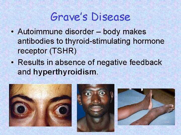 Grave’s Disease • Autoimmune disorder – body makes antibodies to thyroid-stimulating hormone receptor (TSHR)