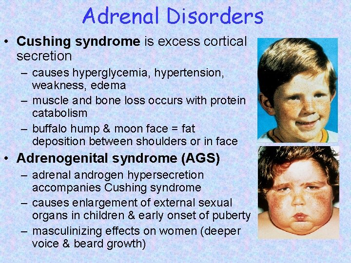 Adrenal Disorders • Cushing syndrome is excess cortical secretion – causes hyperglycemia, hypertension, weakness,
