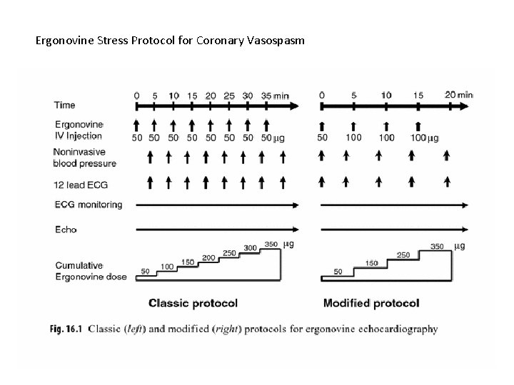 Ergonovine Stress Protocol for Coronary Vasospasm 