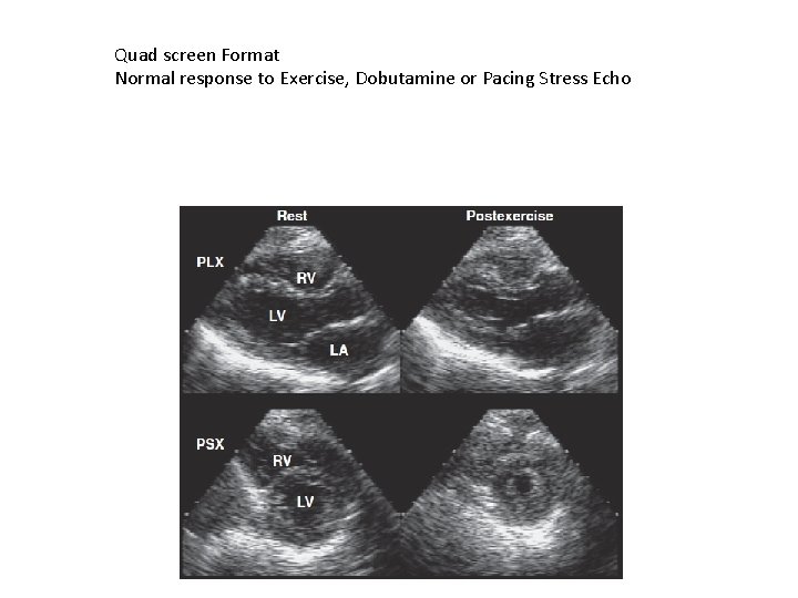 Quad screen Format Normal response to Exercise, Dobutamine or Pacing Stress Echo 
