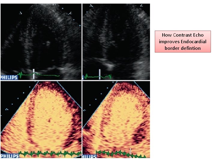 How Contrast Echo improves Endocardial border defintion 