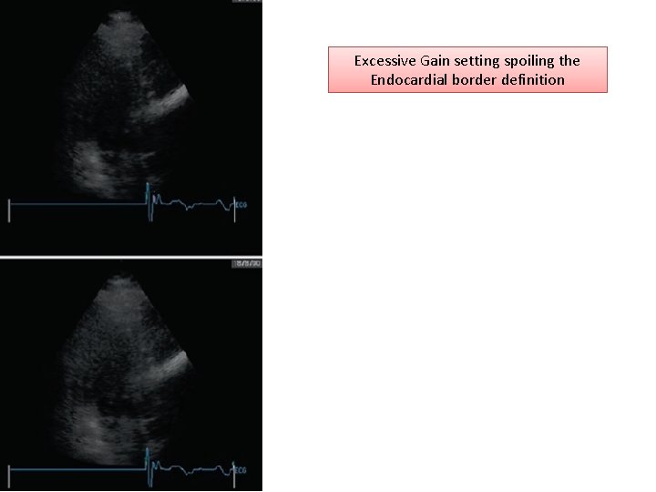 Excessive Gain setting spoiling the Endocardial border definition 