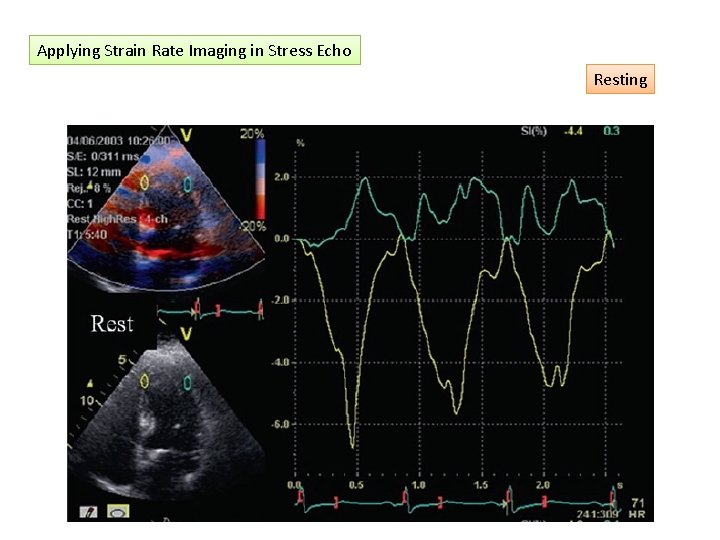 Applying Strain Rate Imaging in Stress Echo Resting 