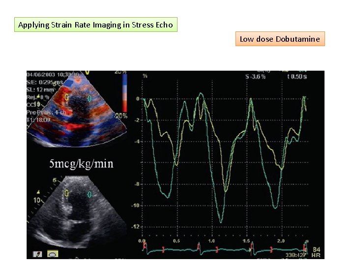 Applying Strain Rate Imaging in Stress Echo Low dose Dobutamine 